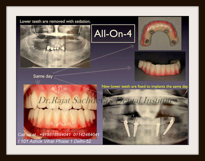 all on 4 dental implant