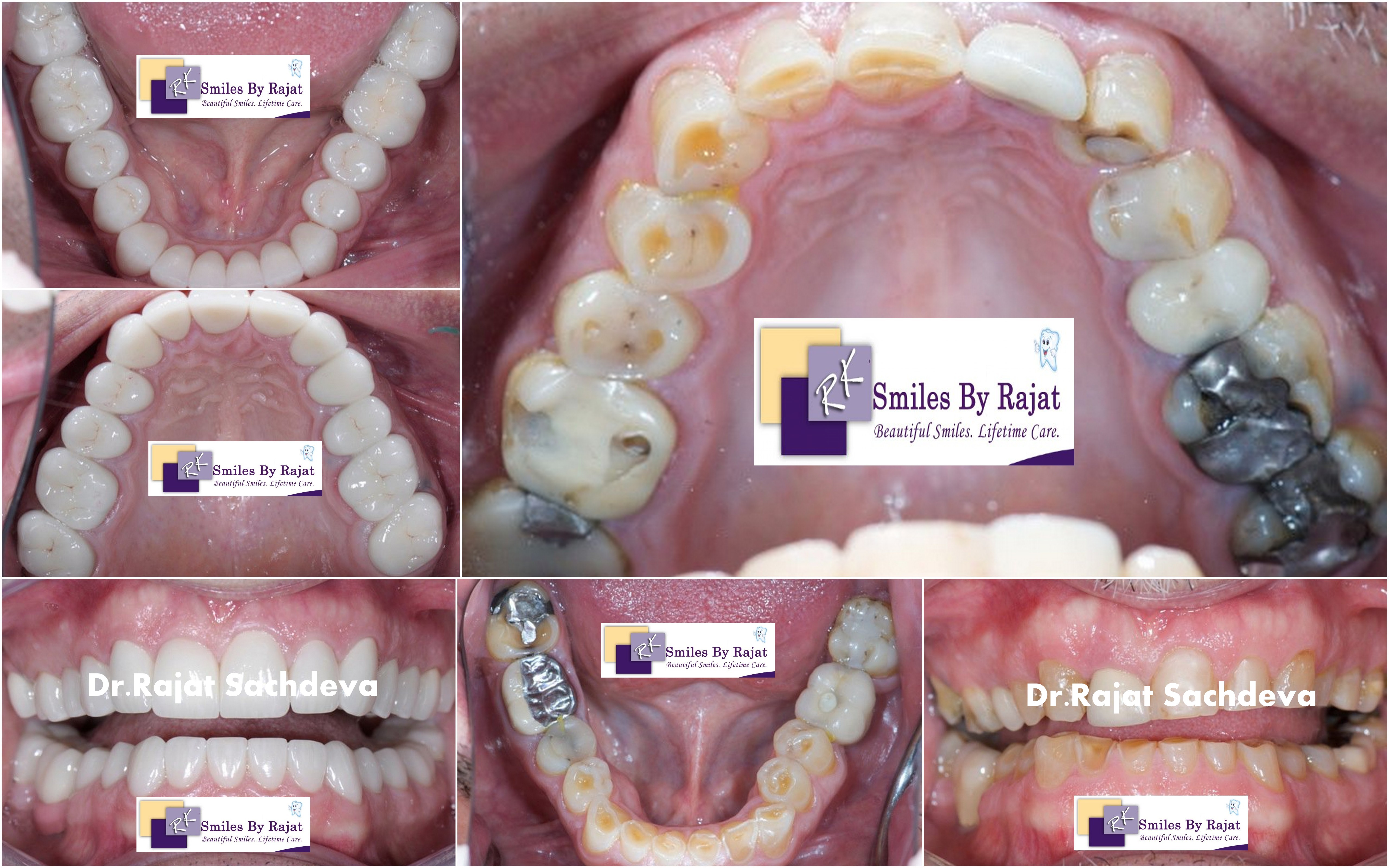 Digital smile Designing Treatment