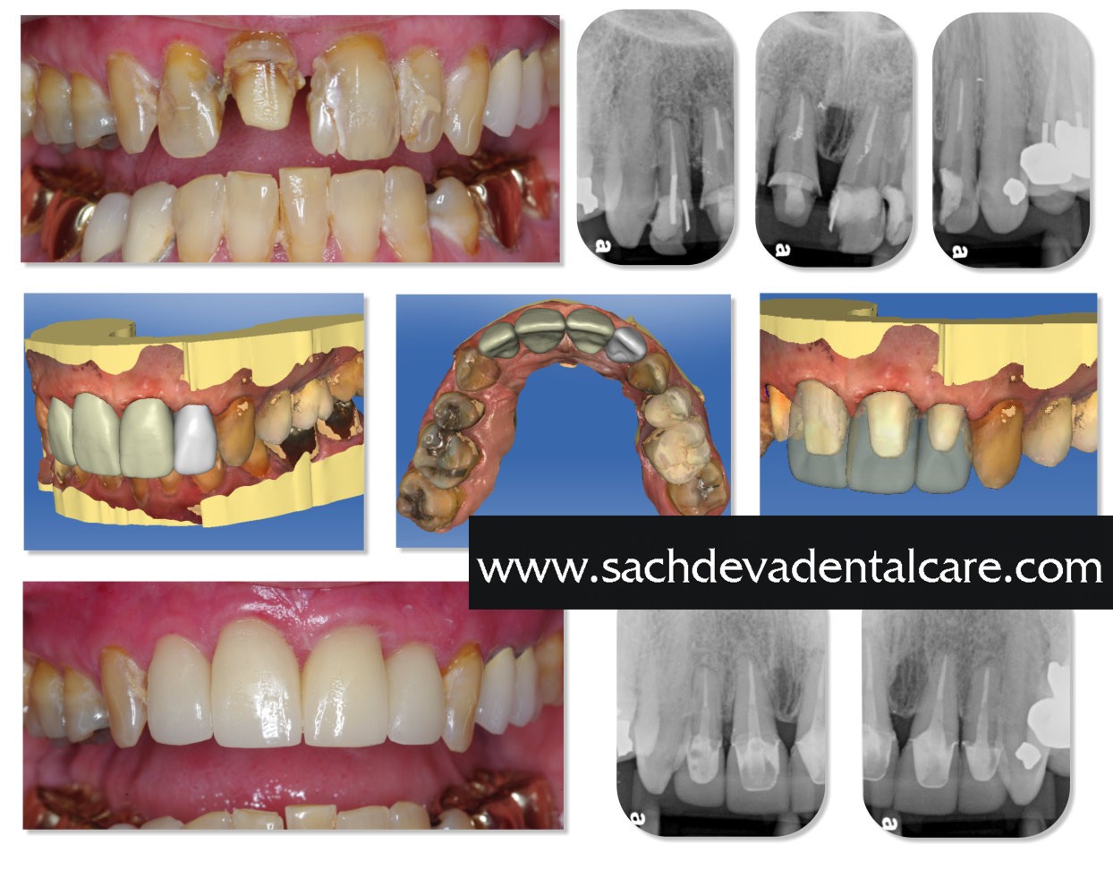 Digital smile Designing Treatment