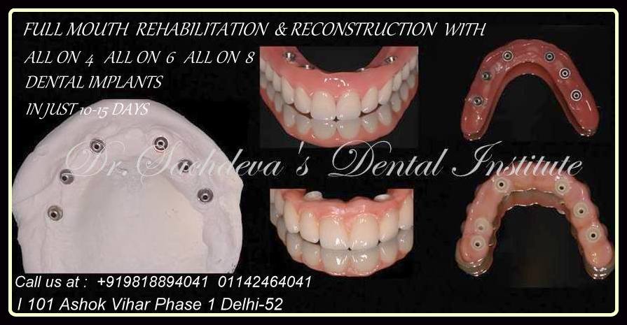 full arch implant