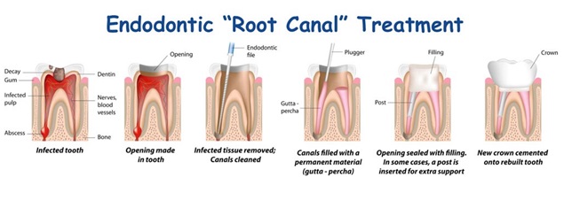 Kids Root Canal Treatment