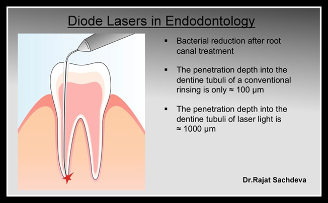 laser dentistry courses in delhi,Laser Dental Courses Delhi,Dentists Delhi,Dental Implants Clinic in Delhi