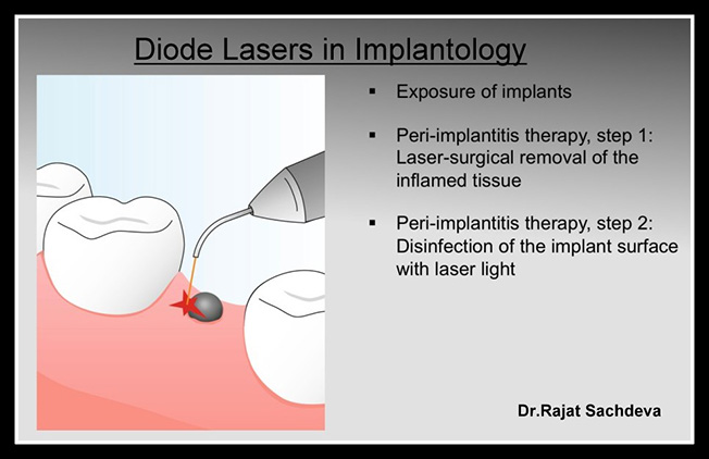 laser dentistry courses in delhi,Laser Dental Courses Delhi,Dentists Delhi,Dental Implants Clinic in Delhi