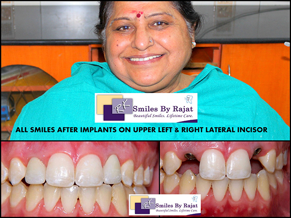 Dental Courses In Delhi,cosmetic dental surgery in delhi ,cosmetic dentist in delhi,Dental Implants Clinic in Delhi,cosmetic dentist delhi,dentist in delhi,dental implant courses in delhi,cost of tooth implant in delhi,tooth implant cost in delhi,cosmetic dentistry in delhi,dental clinic in delhi,laser dentistry courses in delhi,cosmetic dental surgery Delhi