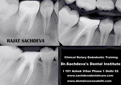 Advanced Endodontics