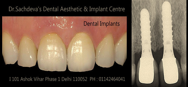 Dental Courses In Delhi,cosmetic dental surgery in delhi ,cosmetic dentist in delhi,Dental Implants Clinic in Delhi,cosmetic dentist delhi,dentist in delhi,dental implant courses in delhi,cost of tooth implant in delhi,tooth implant cost in delhi,cosmetic dentistry in delhi,dental clinic in delhi,laser dentistry courses in delhi,cosmetic dental surgery Delhi