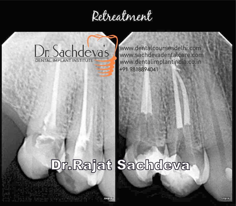 RCT RETREATMENT