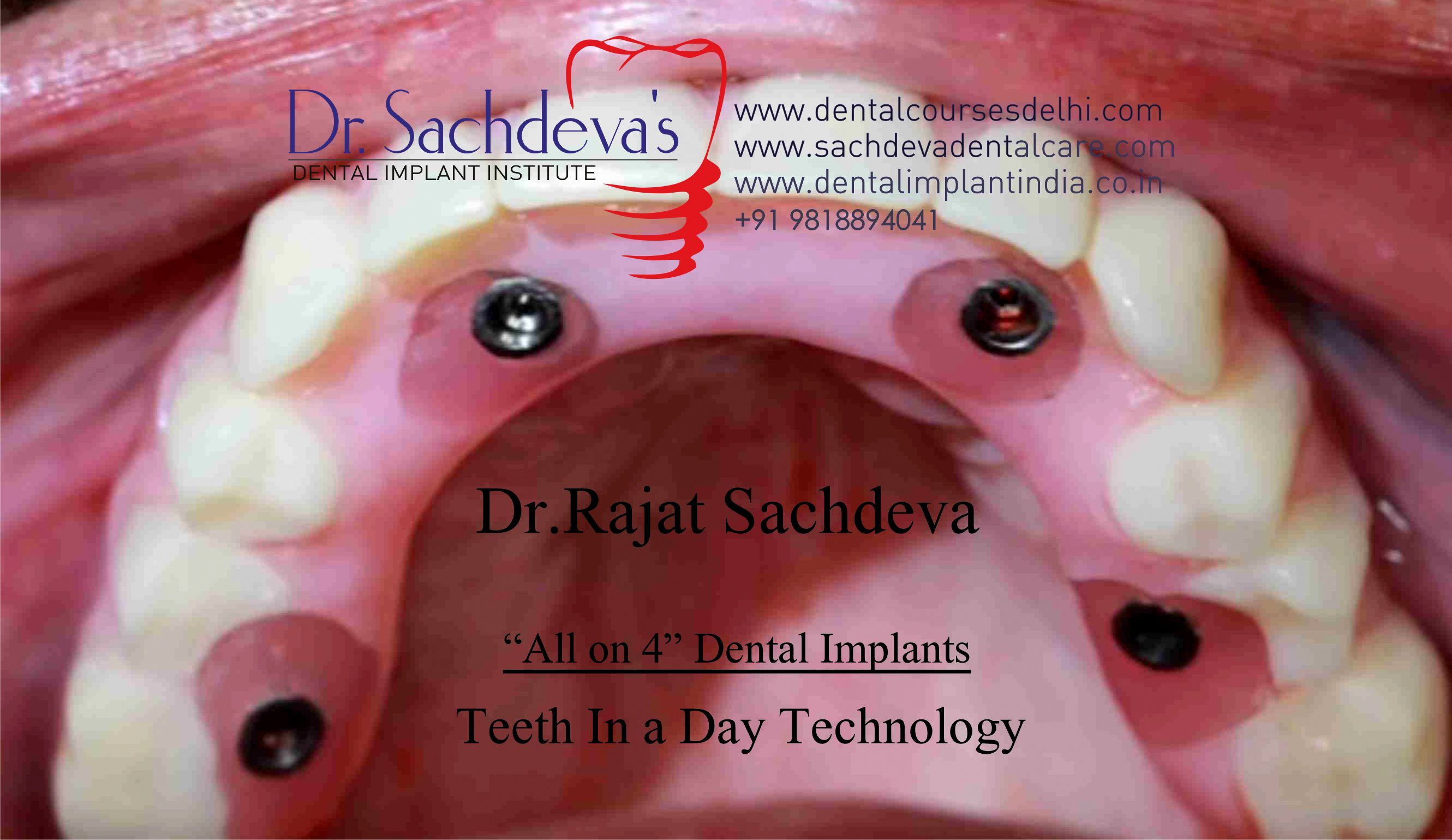 all on 4 dental implant