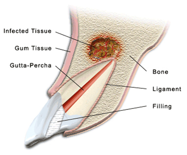 Apicectomy,Dental Courses In Delhi,cosmetic dental surgery in delhi ,cosmetic dentist in delhi,Dental Implants Clinic in Delhi,cosmetic dentist delhi,dentist in delhi,dental implant courses in delhi,cost of tooth implant in delhi,tooth implant cost in delhi,cosmetic dentistry in delhi,dental clinic in delhi,laser dentistry courses in delhi,cosmetic dental surgery Delhi