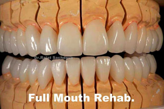 Full Mouth Rehabilitation