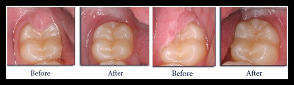 Operculectomy