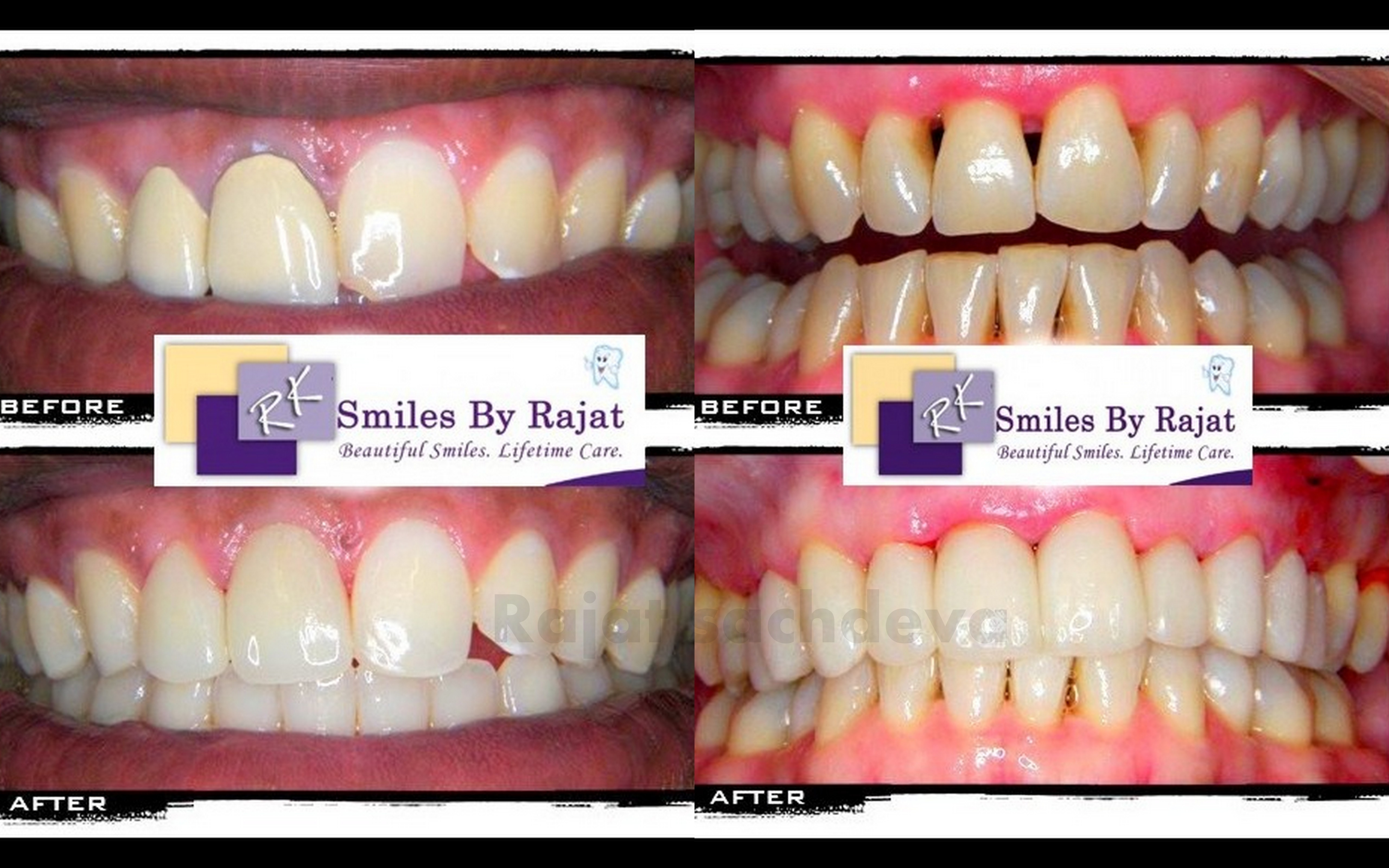 Digital smile Designing Treatment