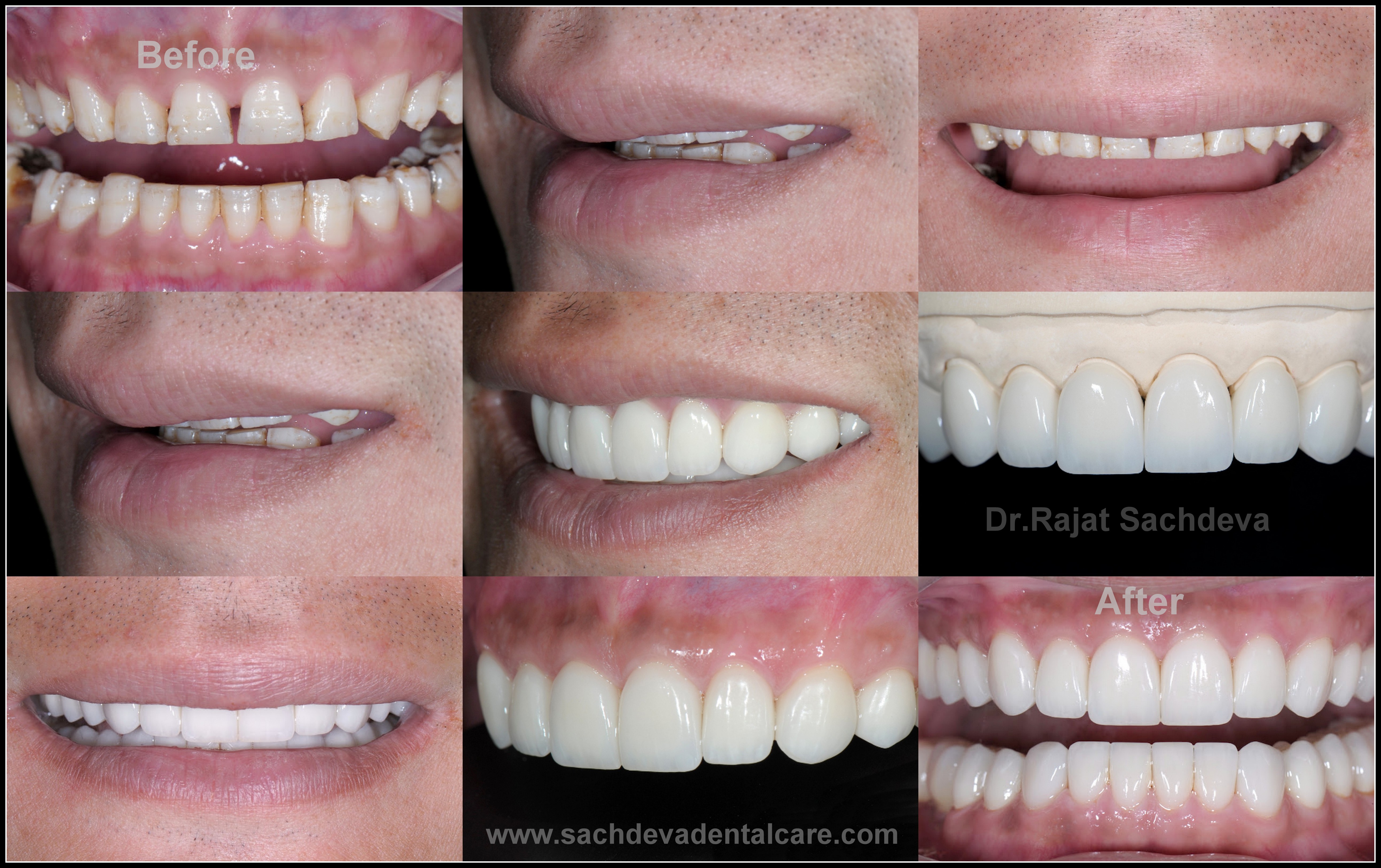 Digital smile Designing Treatment