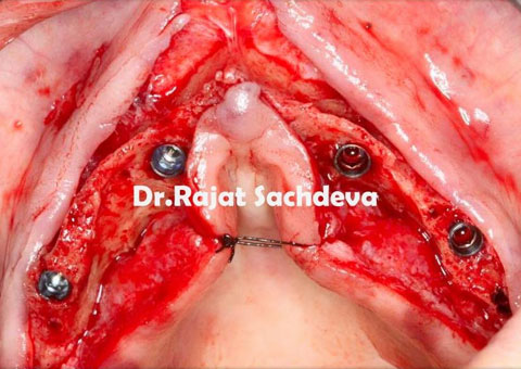 Ridge splitting for lateral ridge Augmentation