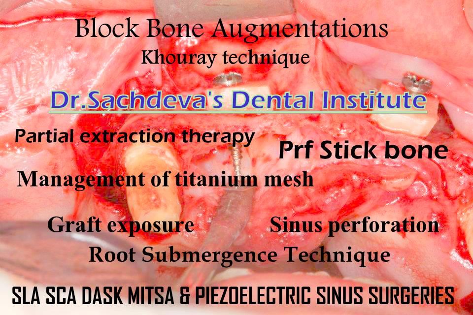 Implanto Dontia Course in India,Implanto Dontia Institute in Delhi