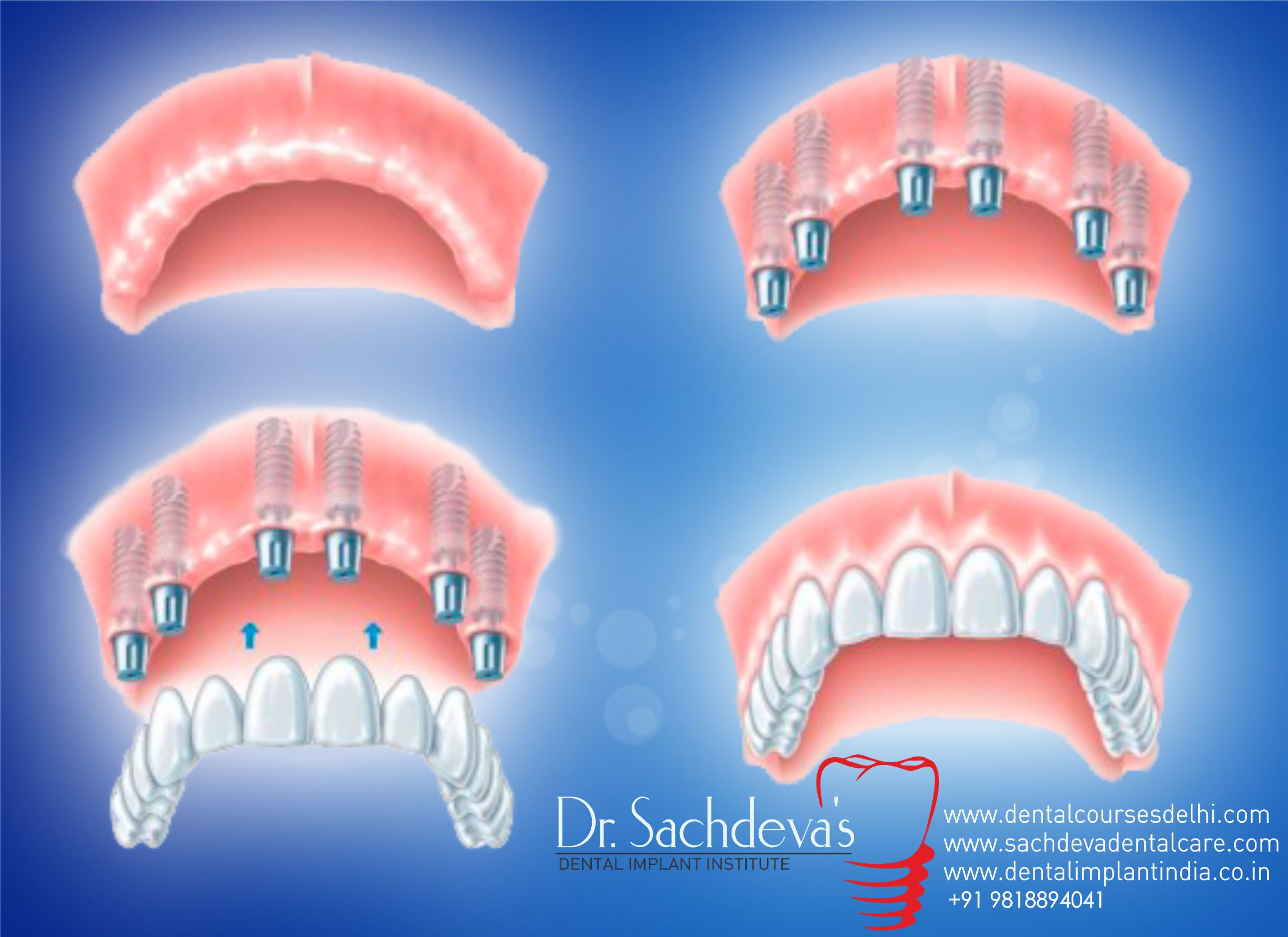 all on 6 dental implant