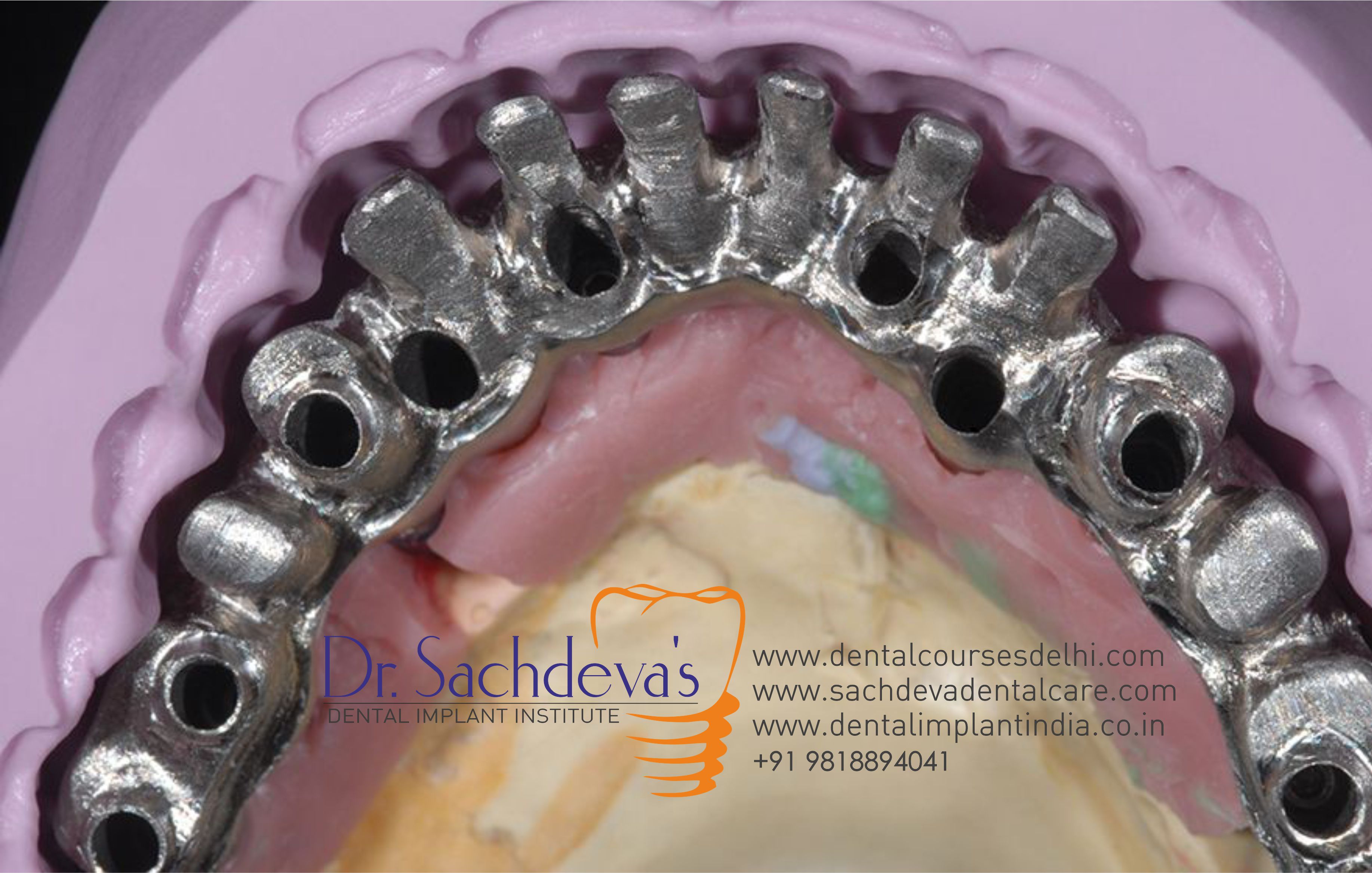 all on 8 dental implant