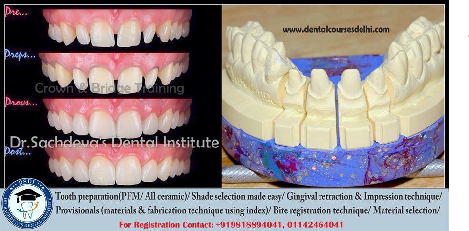 Dental Crown Bridges Veneers