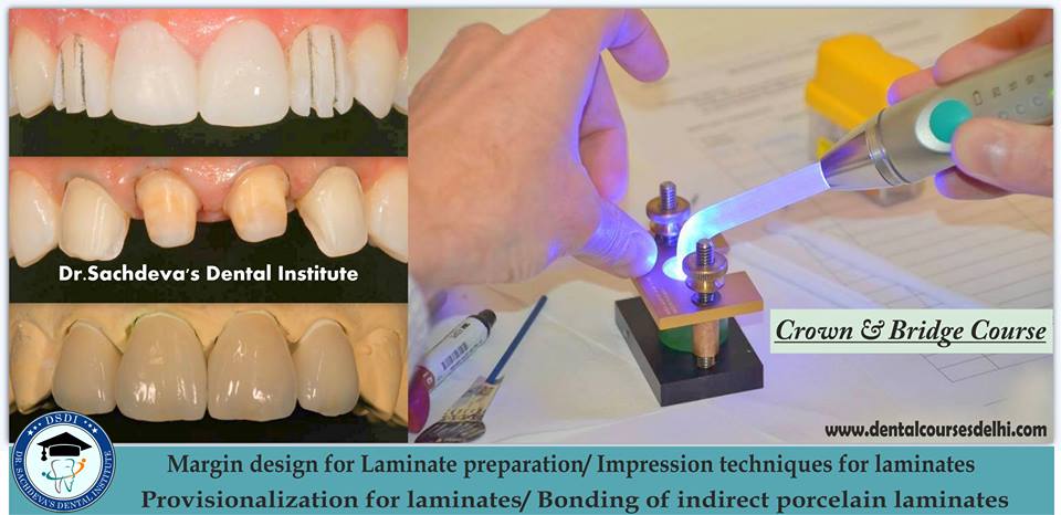 Dental Crown Bridges Veneers