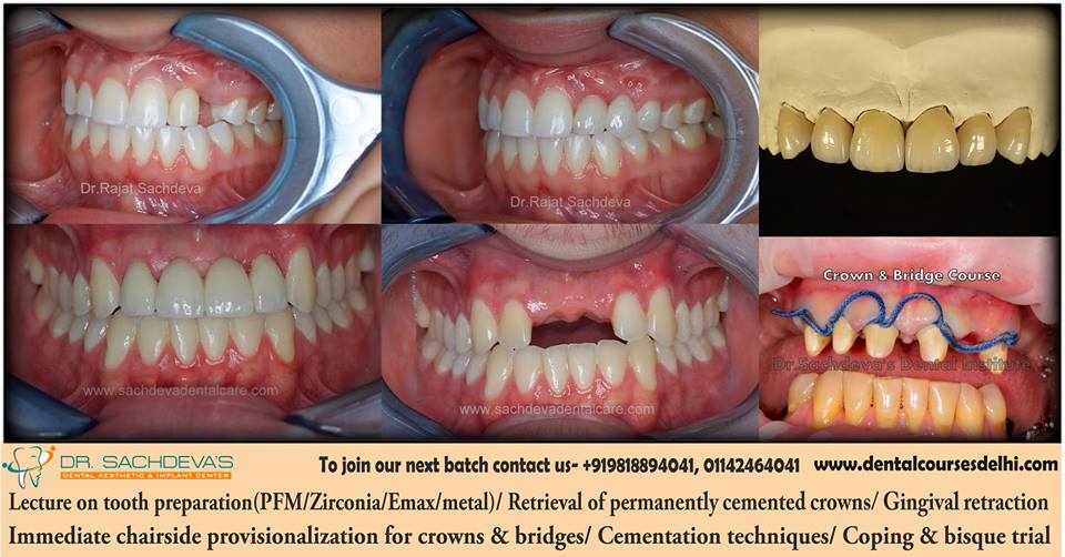 Dental Crown Bridges Veneers